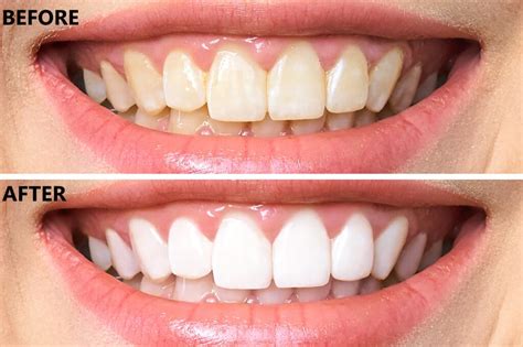 reddit best teeth whitening